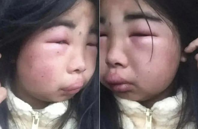 網(wǎng)曝12歲女孩感染HPV事件揭秘，真相與挑戰(zhàn)的應(yīng)對之道