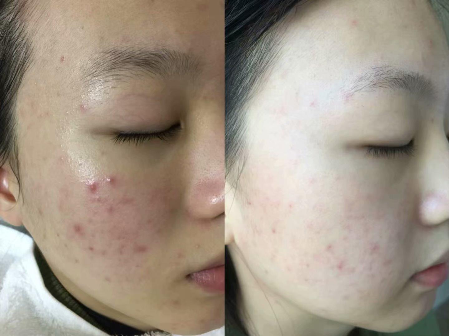 痘痘貼年收入達(dá)6億，市場(chǎng)現(xiàn)象背后的成功解析與洞察