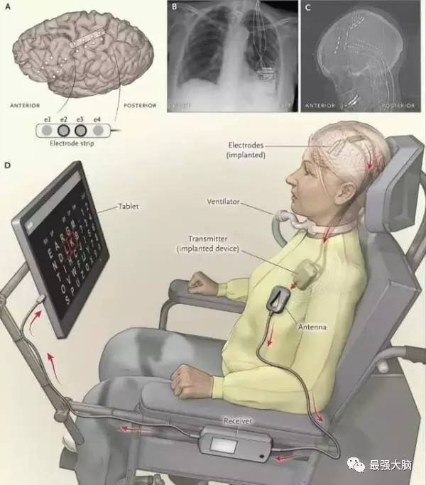 腦機接口助力重度殘疾患者運動能力恢復(fù)